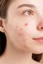 Microplastics in Human Blood: Health Risks, Hormones & Prevention 3 A detailed close-up of a woman's face showing acne blemishes on her skin.